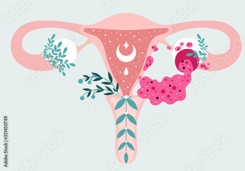 Women health - Floral Infographic of Ovarian cyst rupture with leaking fluid. Patient-friendly scheme of Ovary disease. Gynecological problems - Neutral medical diagram uterus and uterine appendages