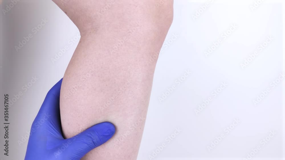 A woman suffers from pain in the calves. Stretching the calf muscle