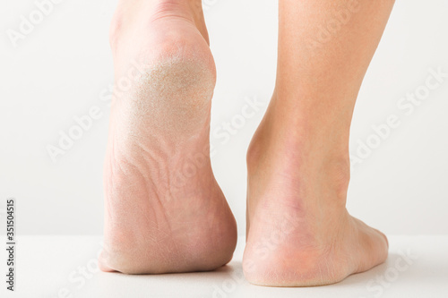 Young woman standing on floor and showing foot with dry skin. Closeup. Light gray background.