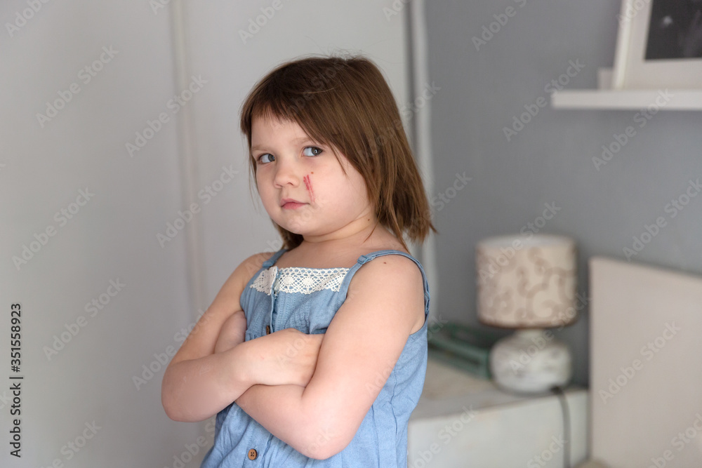 Caucasian child girl with a large scratch on her cheek, childhood injuries and bruises, Caucasian child girl with a large scratch on her cheek, childhood injuries and bruises,
