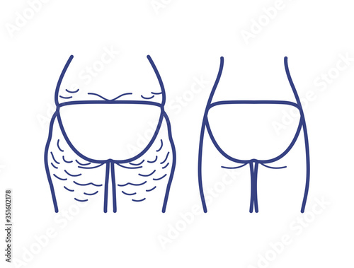 Reduce fat and cellulite at buttock. Vector line Illustration about body care. Before and after