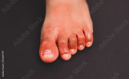 Painful red inflammation on toe called covid toe lesions strange sign of new coronavirus symptoms or infections