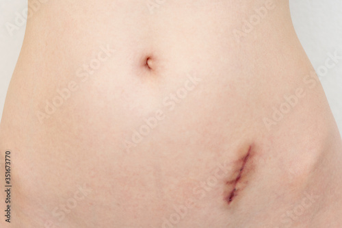 Concept of appendicitis removal. Scar on the skin after removing the appendix  fresh wound  close-up