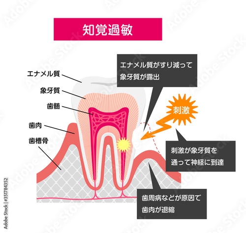 Cause and mechanism of Sensitive teeth vector illustration / Japanese