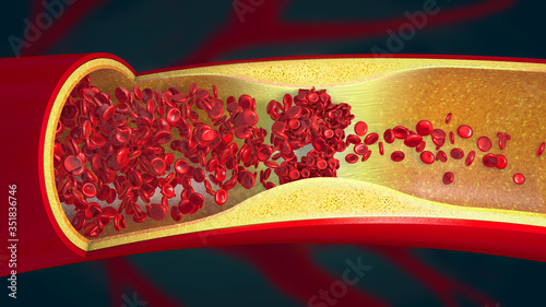 Embolism caused by a blood clot in a constricted blood vessel - 3d illustration photo
