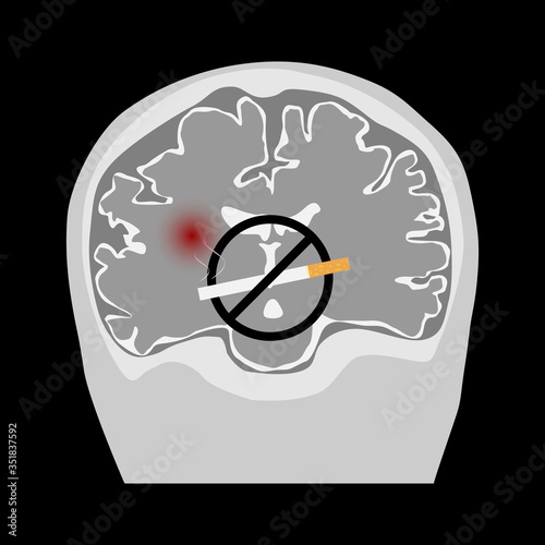 World no tobacco day. Smoking causing stroke.
