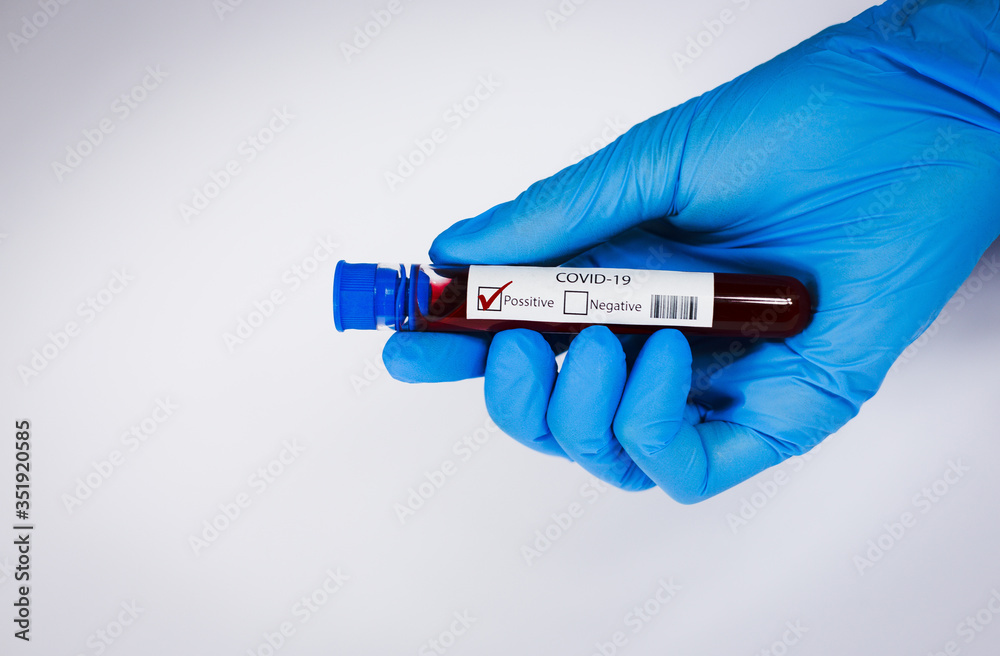 Obraz premium Hand holds a test tube containing a blood positive sample, test tube with blood for Covid-19 (coronavirus) analyzing. Laboratory testing patient’s blood. Blue nitrile glove.