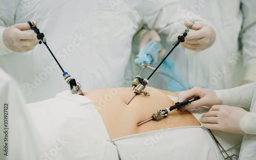 The work of surgeons using endo video of surgical instruments. Laparoscopy. Close-up. Abdominal surgery of a fat or pregnant patient. Endoscopy. Operating room surgical hospital.