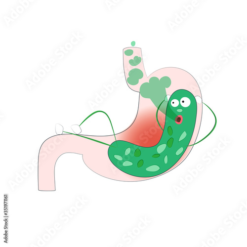 The cartoon bacterium Helicobacter lives in the human stomach. 
Gastritis, ulcers, heartburn, erosion. Vector illustration of diseases 
of the gastrointestinal tract