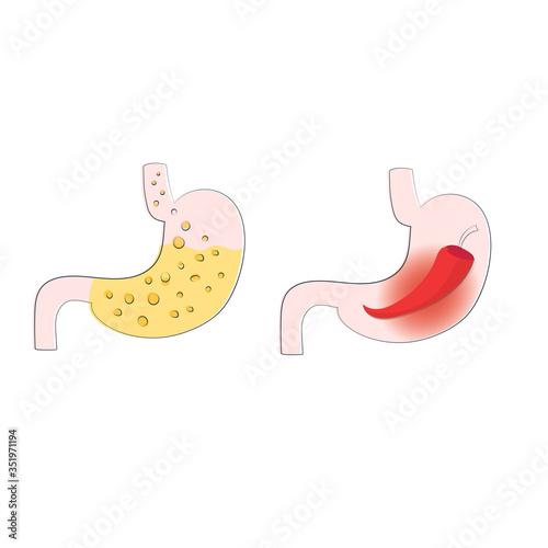 Visualization of stomach heartburn, gastritis and acid reflux, ulcers.  
Strong burning sensation and a full stomach of hydrochloric acid. 
Vector illustration of a disease of the stomach