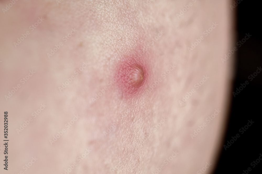 pimple on skin infection Pimple to Popping pimple on skin infection Pimple to Popping