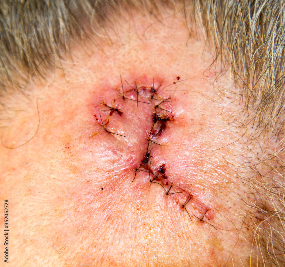 Fototapeta premium Sutures in cut using flap technique on face for removal of melanoma in situ.