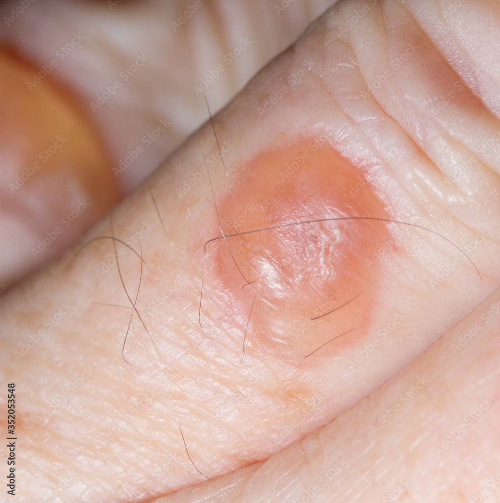 Blisters From Cryotherapy Treatment For Solar Keratos - vrogue.co