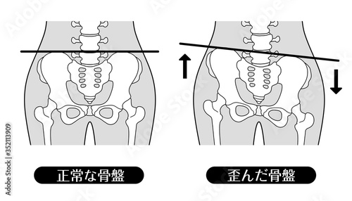 正常な骨盤と歪んだ骨盤（モノクロ）