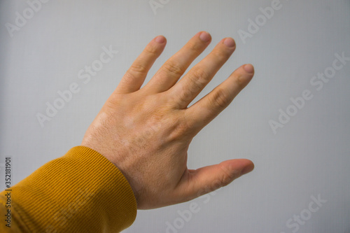 A caucasian man's hand covered with white vitiligo spots. Vitiligo is an autoimmune disorder that causes skin pigment loss in form of white patches. It is not contagious and does not cause pain.