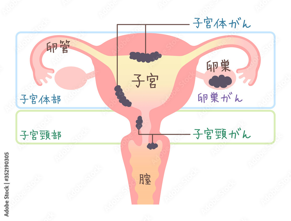 子宮がん 卵巣がんのイラスト 図説 文字あり Stock Vector Adobe Stock