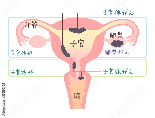 子宮がん・卵巣がんのイラスト・図説（文字あり）
