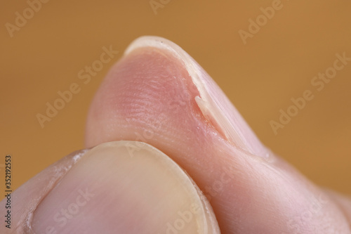 手の親指の巻き爪
