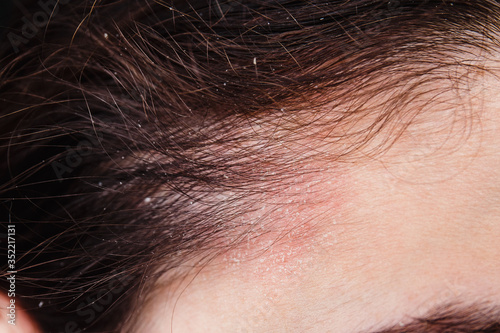 Dandruff in the hair and temples of a young woman. Dry scalp skin itches