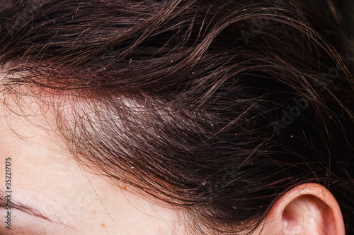 Dandruff in the hair and temples of a young woman. Dry scalp skin itches