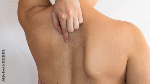 The woman points a finger at the scar on her back.