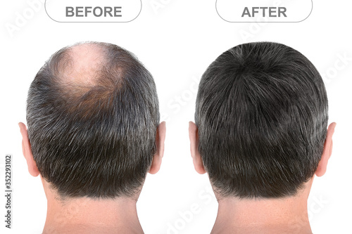 Back view of male head before and after hair extensions photo
