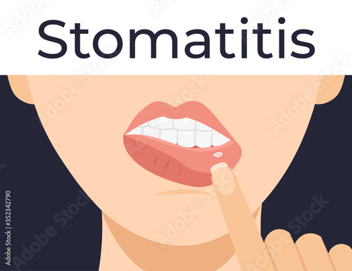 Stomatitis. Woman has inflammation of the mouth and lips. Flat vector cartoon modern illustration. photo