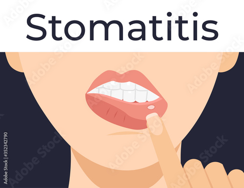 Stomatitis. Woman has inflammation of the mouth and lips. Flat vector cartoon modern illustration.