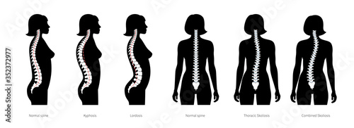 Spinal deformity flat vector illustration
