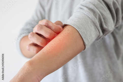 Young asian man itching and scratching on arm from itchy dry skin eczema dermatitis
