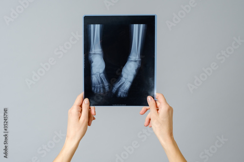 Female doctor examining x-ray image of legs of newborn baby photo