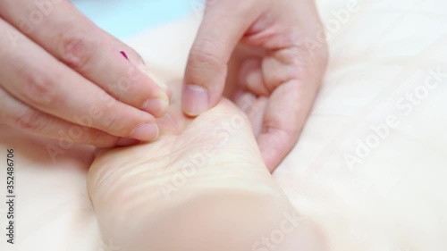 4K Close-up of dry needling therapy applied at under feet of woman at physiotherapy session, Therapist Giving acupuncture Treatment Woman feet to heal muscle that injured from wearing high heel shoes. photo