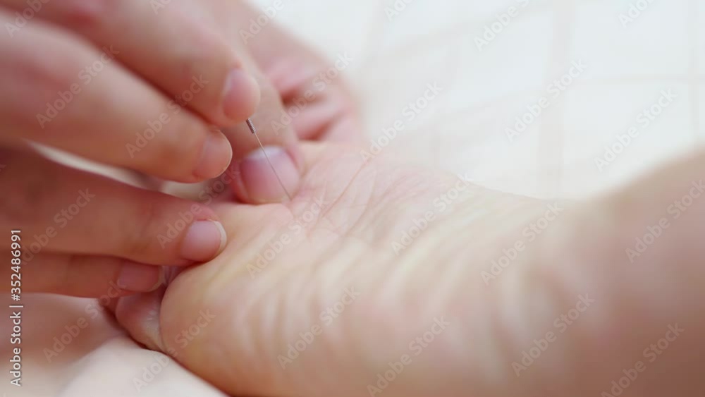 4K Close-up of dry needling therapy applied at under feet of woman at physiotherapy session, Therapist Giving acupuncture Treatment Woman feet to heal muscle that injured from wearing high heel shoes. 4K Close-up of dry needling therapy applied at under feet of woman at physiotherapy session, Therapist Giving acupuncture Treatment Woman feet to heal muscle that injured from wearing high heel shoes.