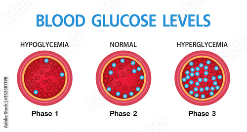 Hyperglycemia, High Blood Sugar and Diabetes ,obesity is a serious medical condition causes, vector design.