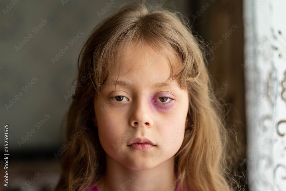 Portrait of a sad and scared little girl with beating. Child domestic abuse. Portrait of a sad and scared little girl with beating. Child domestic abuse.