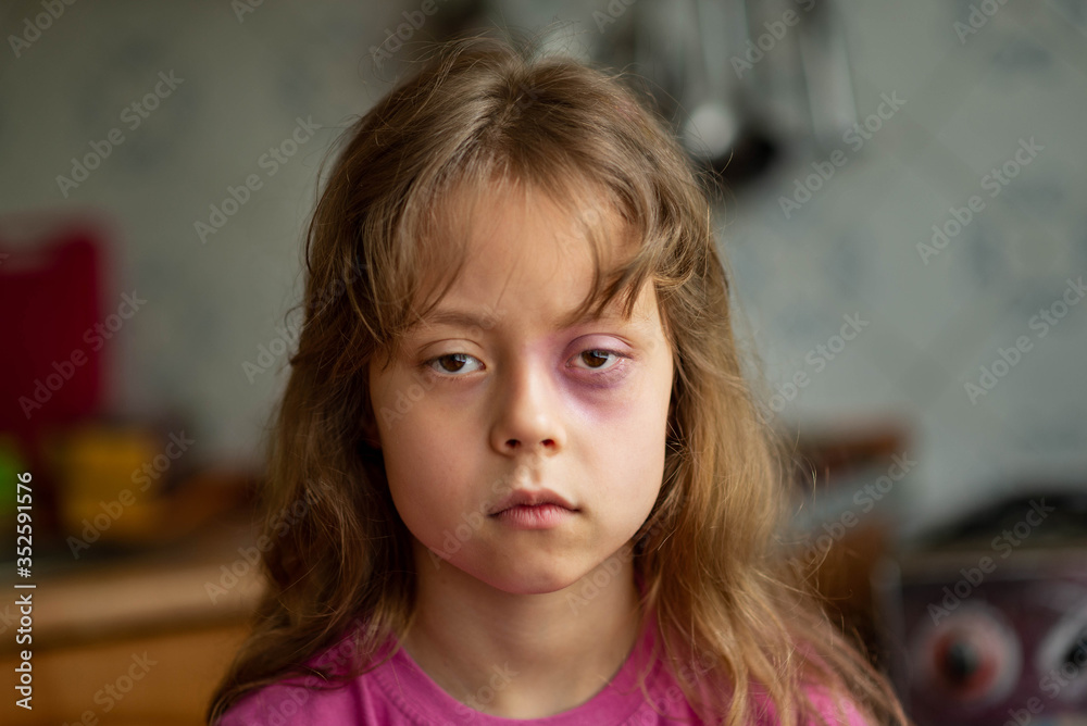 Portrait of a sad and scared little girl with beating. Child domestic abuse. Portrait of a sad and scared little girl with beating. Child domestic abuse.