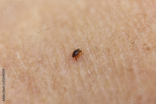 Tick bitten in human skin 6