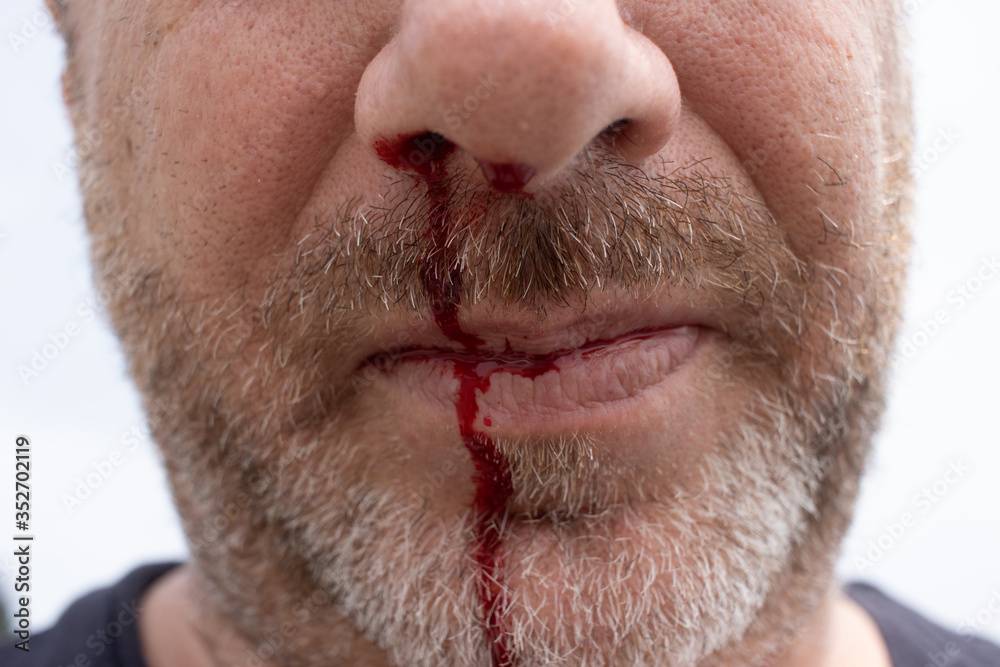 nosebleed , A man is bleeding from his nose nosebleed , A man is bleeding from his nose