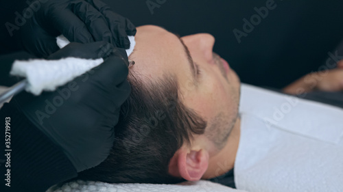 High quality close-up of a man laying on a couch during the esthetician hair treatment. Male tricopigmentation service. Scalp micropigmentation treatment. Trichopigmentation procedure. photo