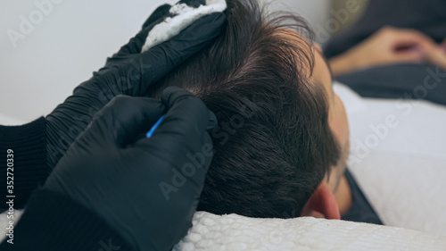 High quality close-up of a man laying on a couch during the esthetician hair treatment. Male tricopigmentation service. Scalp micropigmentation treatment. Trichopigmentation procedure.