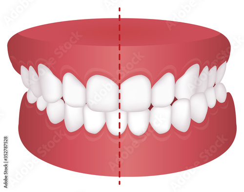 Teeth trouble ( bite type ) vector illustration / Crossbite (misalignment) photo