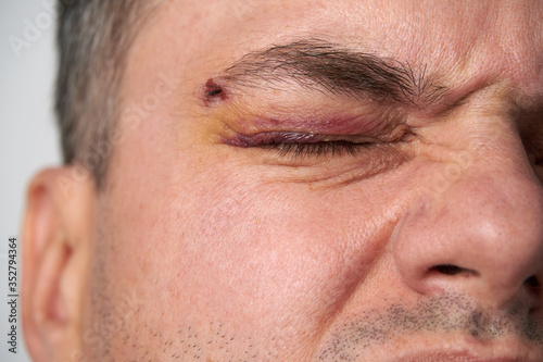 close view of a black eye, man's face with a hematoma