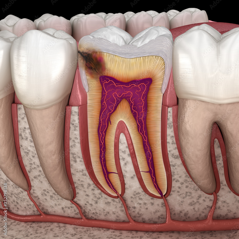 Hidden caries in to molar tooth. Medically accurate 3D illustration Hidden caries in to molar tooth. Medically accurate 3D illustration