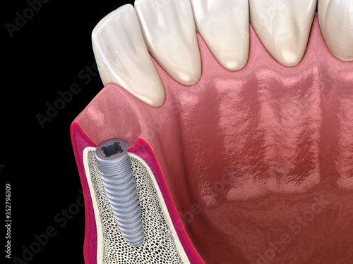 Instaled dental implantat. Medically accurate tooth 3D illustration. photo