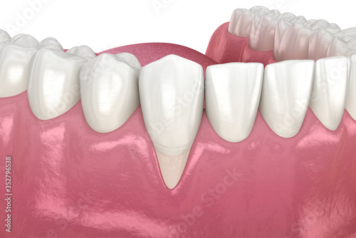 Fototapeta Gum Recession. 3D illustration of Dental problem