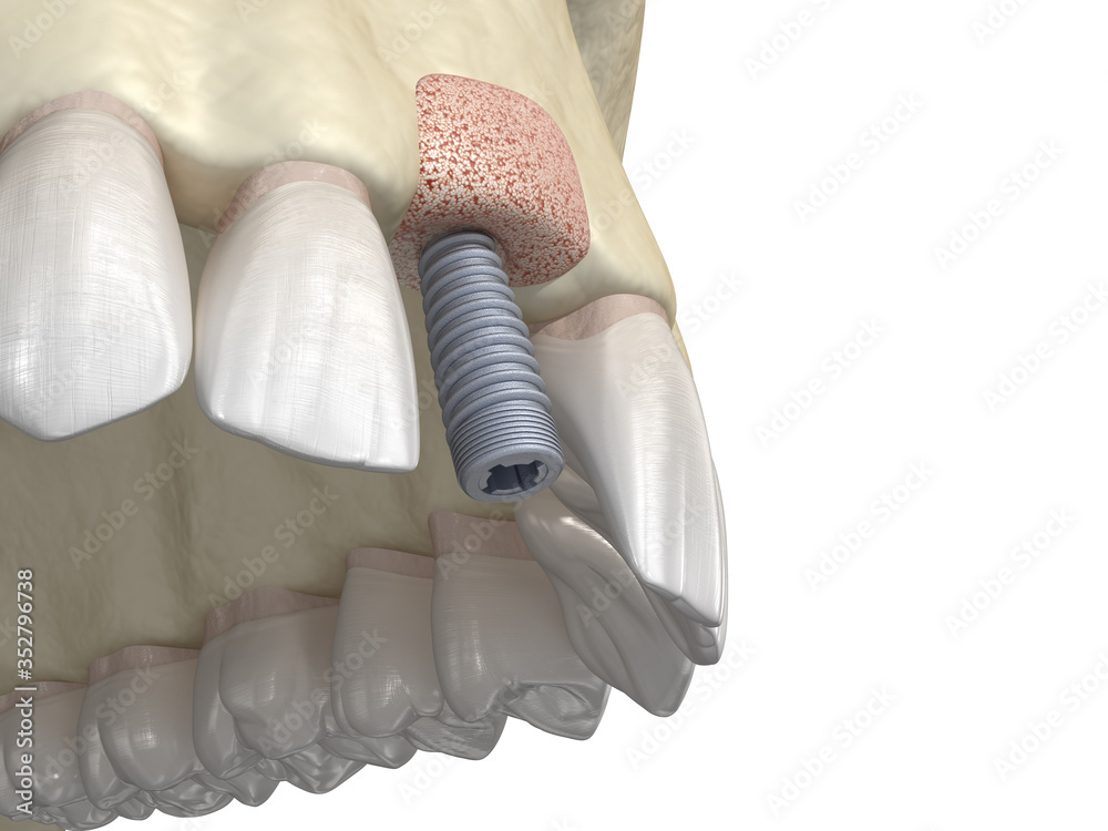 Bone grafting- augmentation using ring method, tooth implantation. Medically accurate 3D illustration - obrazy, fototapety, plakaty 