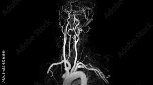 Magnetic Resonance Angiography(MRA)of the brain or cta brain 3D Rendering image white color rotating on the screen from mra scanner. medical footage concept..