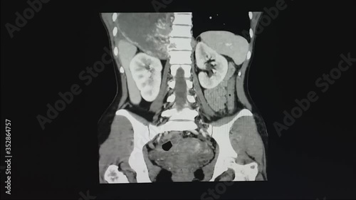 MRI OF THE THORACOLUMBAR SPINE: a 30 year old female pressented with retroperitoneal mass,to rule out TB spine.Medical healthcare image concept.