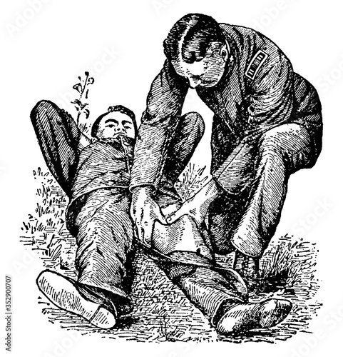 Femoral compression, vintage illustration