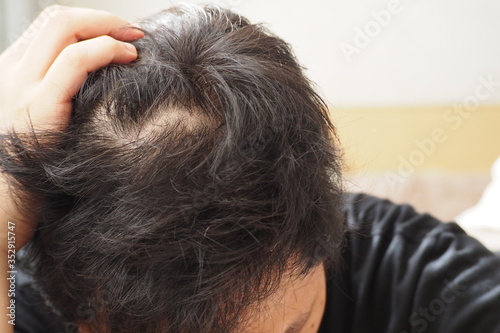 Young Asian man using his hand slicking his hair back after facing hair loss problem Take medicine like zinc and biotin to make his hair grow faster and thicker. Men health and medical concept
